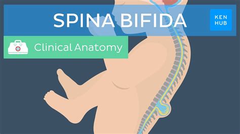 Spina Bifida: Causes, Symptoms, Diagnoses, and Treatment